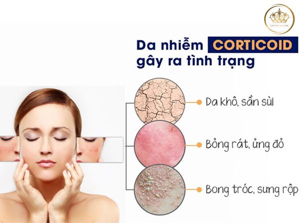 Những dấu hiệu thường gặp của làn da bị nghiện corticod nàng cần biết